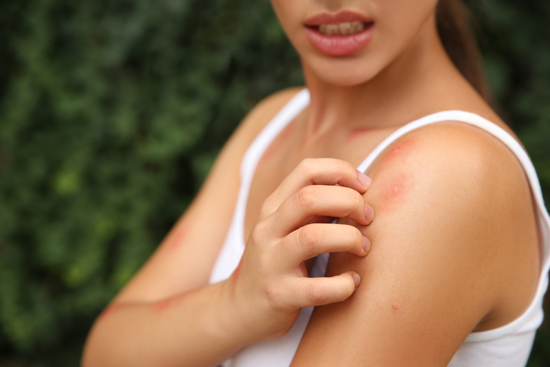 woman scratching bug bites on shoulder